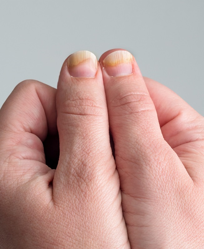 grzybica paznokci u rąk po hybrydzie 