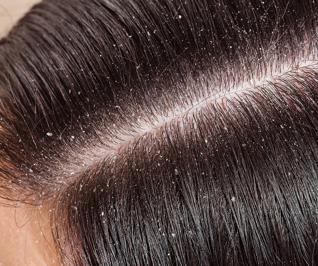 łupież suchy a tłusty