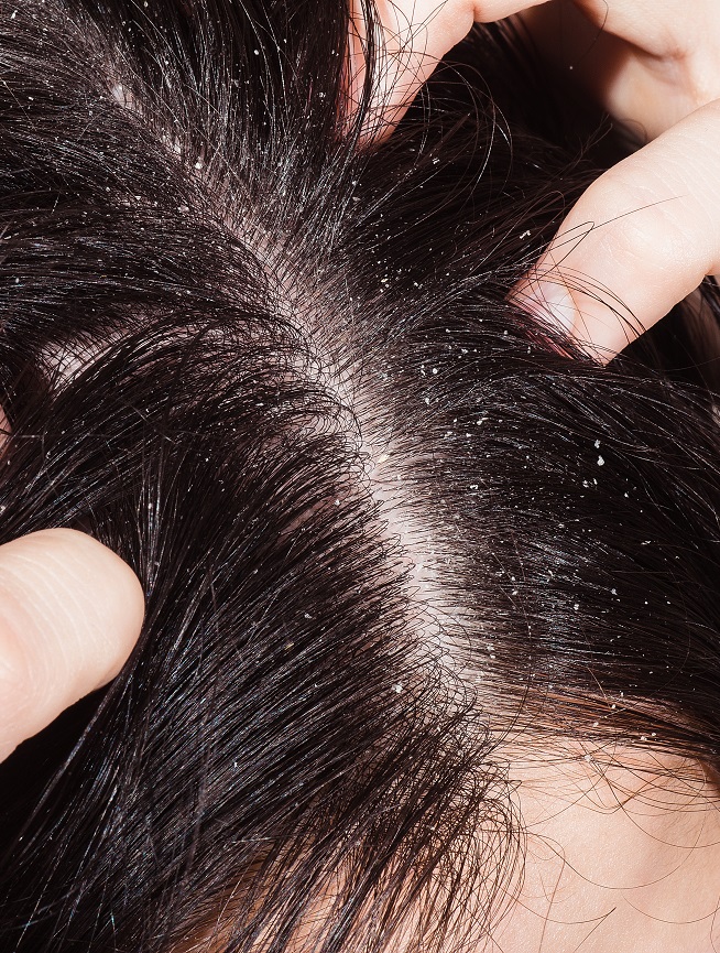 objawy łupieżu suchego