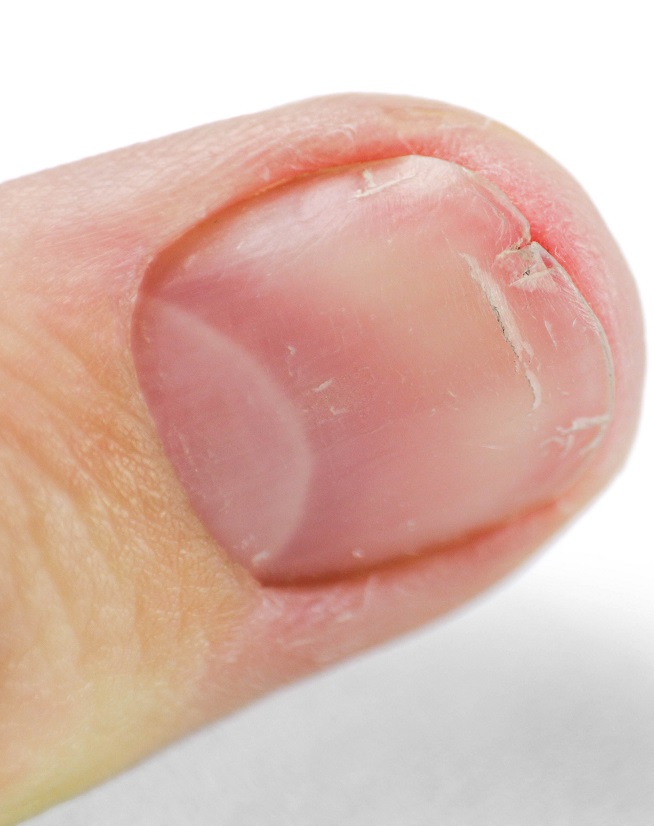 rozdwajające się paznokcie u rąk