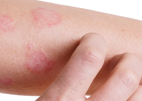 Pirolam® roztwór na skórę